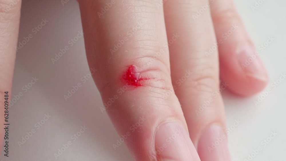 gellike red blood clot at the site of a cut on a woman's middle finger