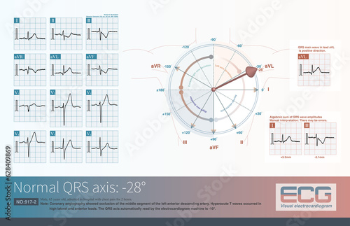 When the frontal QRS axis is at -28°, the QRS amplitude of lead aVL is the highest.The amplitude of the biphasic wave in lead II is nearly equal. photo