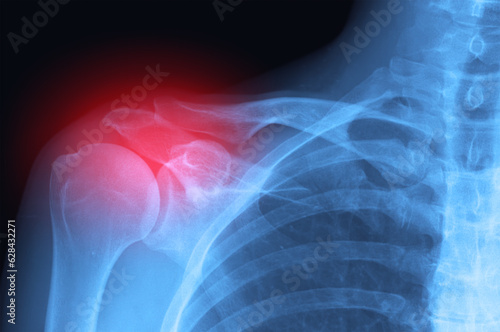 Real X-ray scan - joint inflammation or broken arm and shoulder trauma pain. Radiology diagnosis.