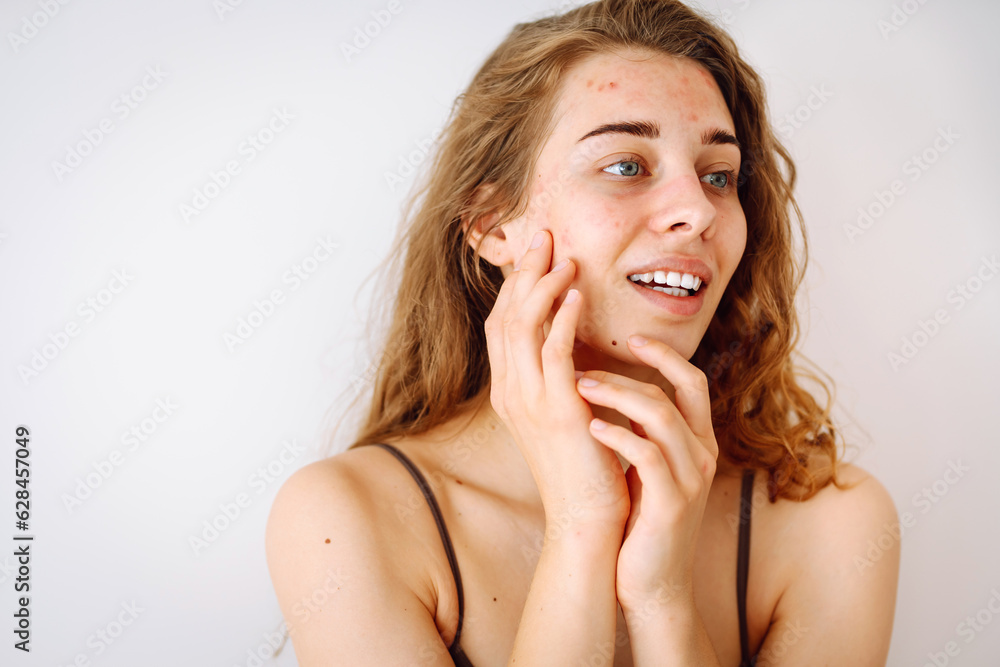 Fototapeta premium Portrait of a beautiful young woman with inflammations on the skin of her face. Medicine and cosmetology. Smiling woman with problem skin on a sunny day. Copy space.