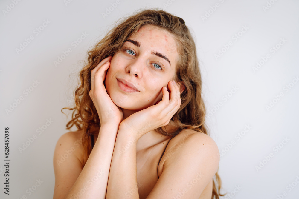 Portrait of a beautiful young woman with inflammations on the skin of her face. Medicine and cosmetology. Smiling woman with problem skin on a sunny day. Copy space. Portrait of a beautiful young woman with inflammations on the skin of her face. Medicine and cosmetology. Smiling woman with problem skin on a sunny day. Copy space.