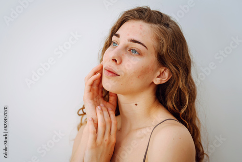 Portrait of a beautiful young woman with inflammations on the skin of her face. Medicine and cosmetology. Smiling woman with problem skin on a sunny day. Copy space. photo