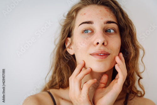 Portrait of a beautiful young woman with inflammations on the skin of her face. Medicine and cosmetology. Smiling woman with problem skin on a sunny day. Copy space. photo