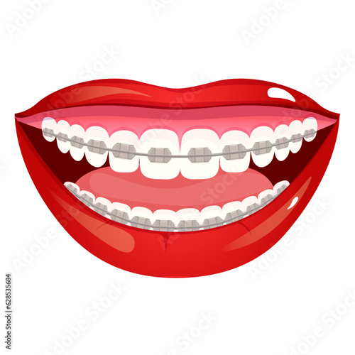 Girl red lips smile with teeth with orthodontic braces