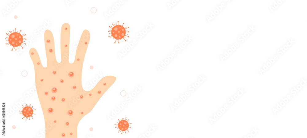 Hand with virus infection