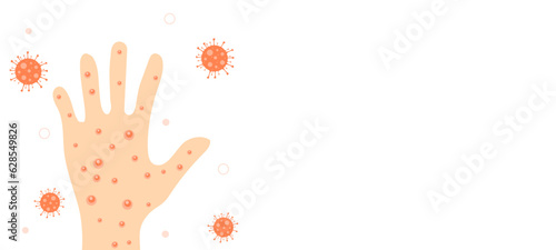 Hand with virus infection