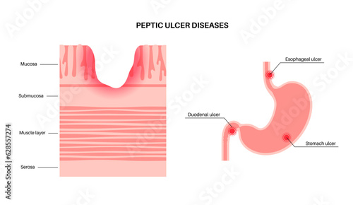 Peptic ulcer disease photo