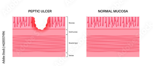 Peptic ulcer disease