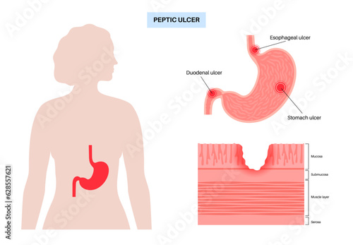 Peptic ulcer disease