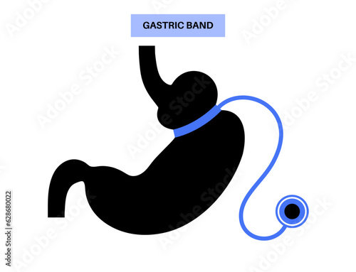 Gastric band poster