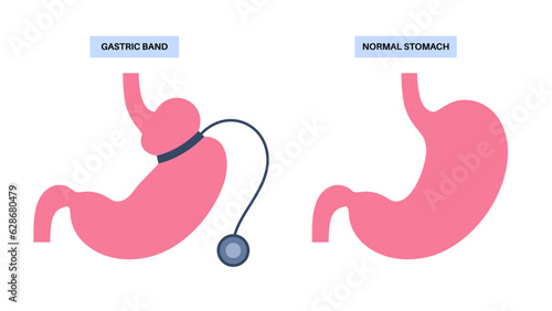 Gastric band poster