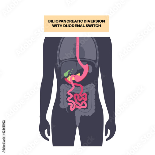 Biliopancreatic diversion procedure