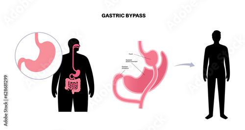 Gastric bypass surgery