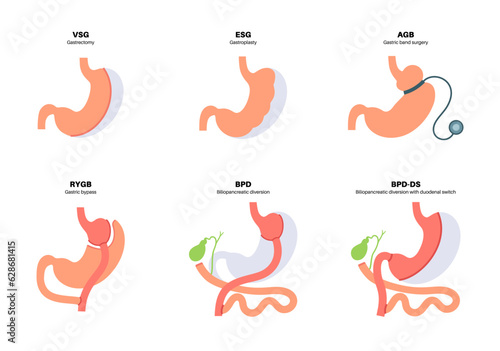 Bariatric surgery poster