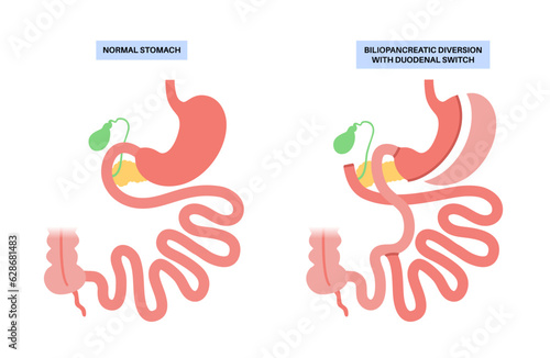 Biliopancreatic diversion procedure