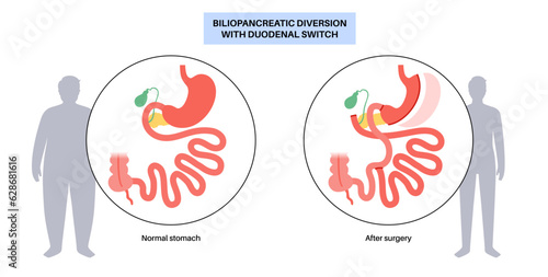 Biliopancreatic diversion procedure