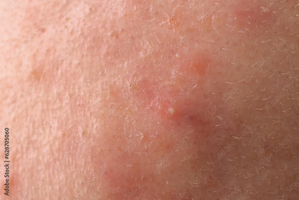 Fototapeta premium Young person with acne problem, closeup view of skin
