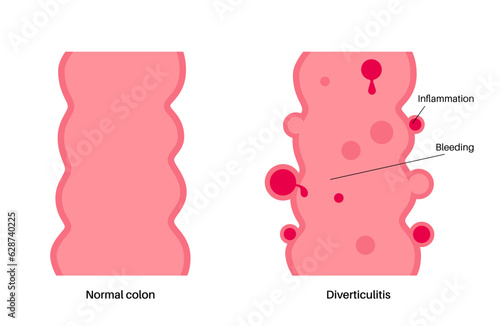 Diverticulitis and diverticulosis