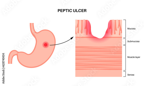 Peptic ulcer disease