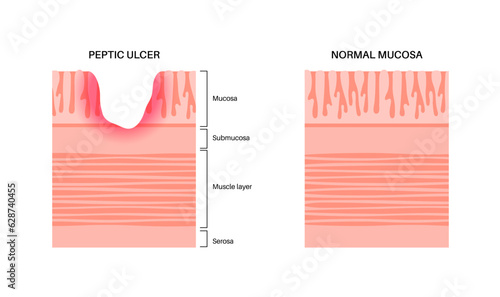 Peptic ulcer disease