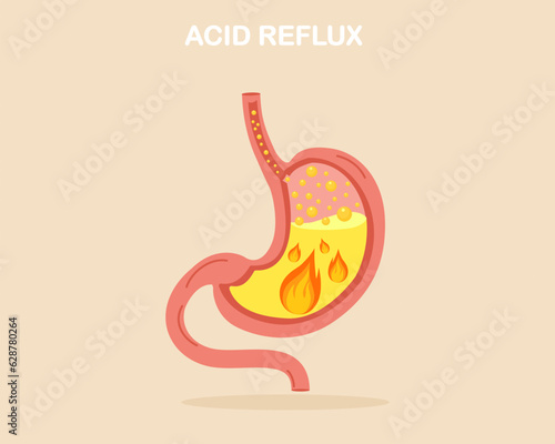 Suffering from GERD symptom with acid reflux stomach heartburn with burning acid inside digestive system gastritis problem.