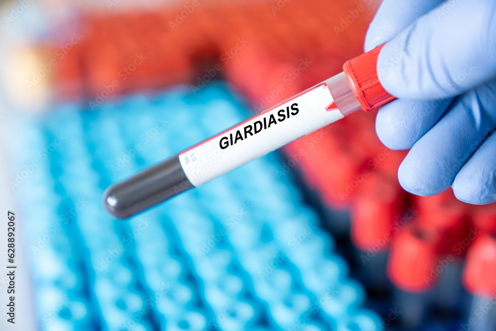 Fototapeta premium Giardiasis. Giardiasis disease blood test in doctor hand