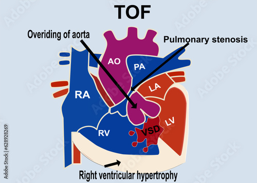 The picture show the structure of tetralogy of fallot that show the 4 part defect of heart which is overriding of aorta , pulmonary stenosis  ,VSD, right ventricular hypertrophy for medical concept
