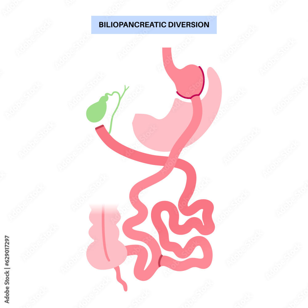 Biliopancreatic diversion procedure Biliopancreatic diversion procedure