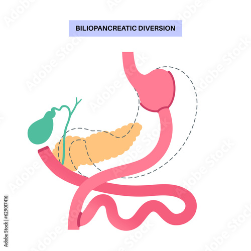 Biliopancreatic diversion procedure