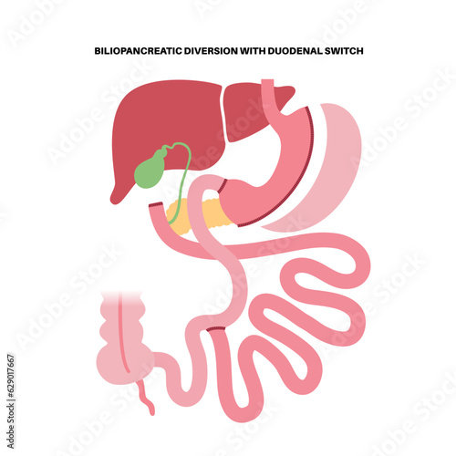 Biliopancreatic diversion procedure