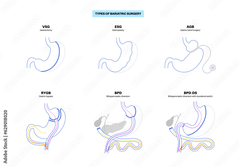 Obraz premium Bariatric surgery poster