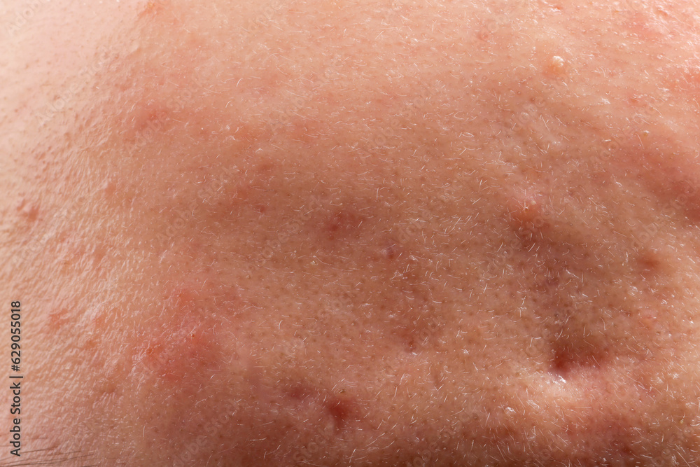 Young person with acne problem, closeup view of skin Young person with acne problem, closeup view of skin
