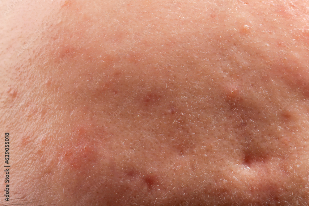 Young person with acne problem, closeup view of skin