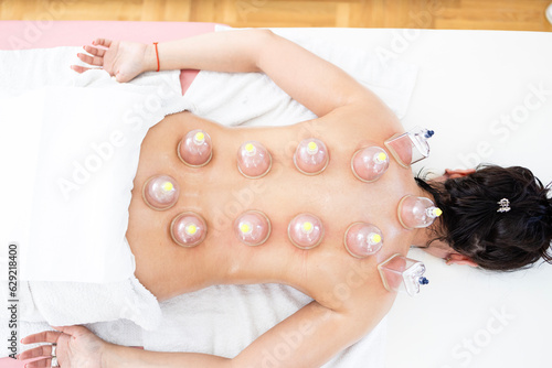 Top view of hijama cupping treatment on woman's back. photo