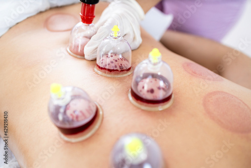 Fotografía Close up view of vacuum cups filled with blood during hijama cupping therapy