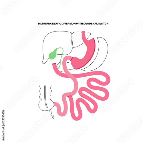 Biliopancreatic diversion procedure