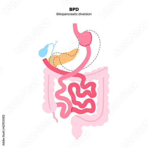 Biliopancreatic diversion procedure