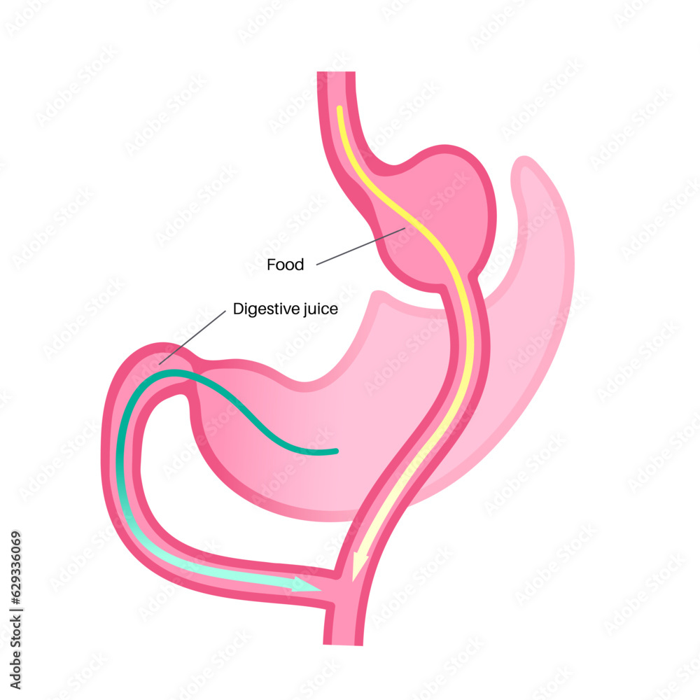 Obraz premium Gastric bypass surgery