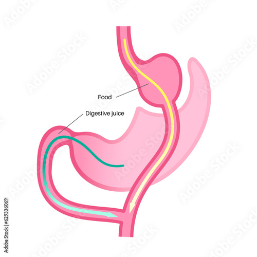 Gastric bypass surgery