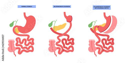 Biliopancreatic diversion procedure