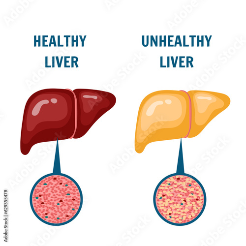 Medical infographic of healthy and unhealthy fatty liver in vector