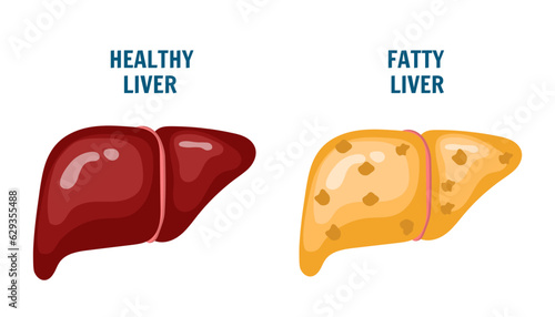 Medical infographic of healthy and unhealthy fatty liver in vector