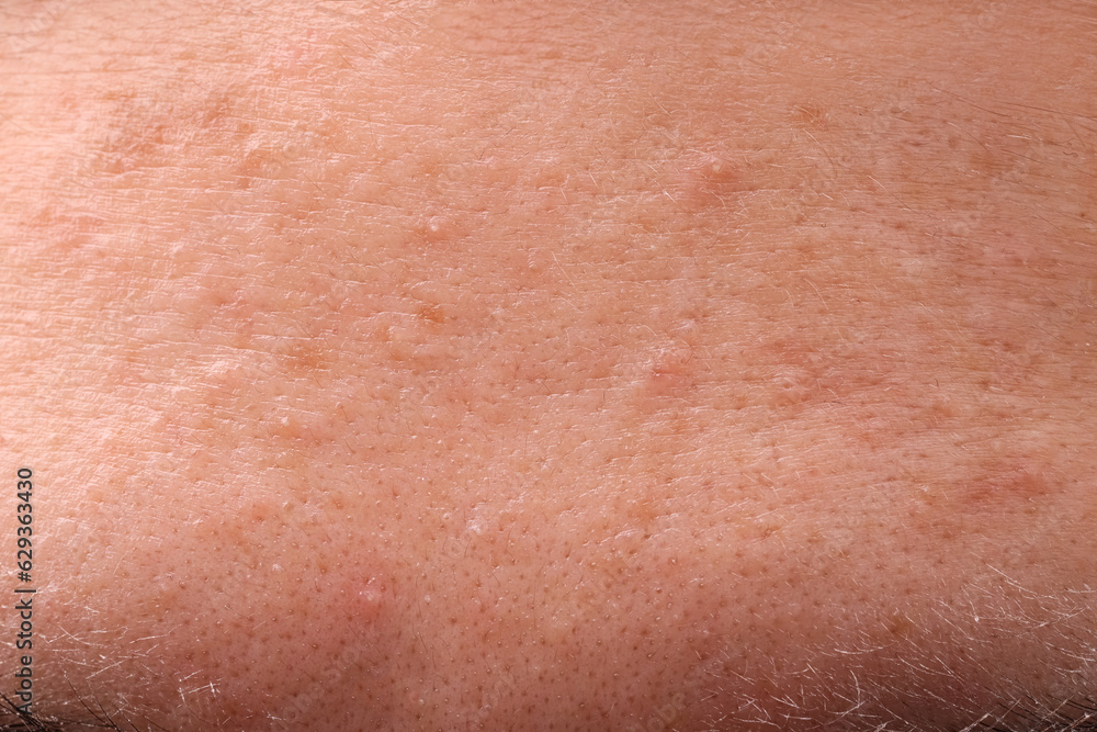 Fototapeta premium Young woman with acne problem, closeup view