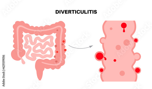 Diverticulitis and diverticulosis photo