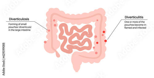 Diverticulitis and diverticulosis