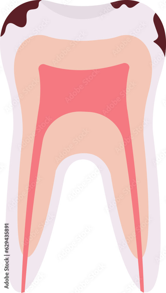 Caries Tooth Problem