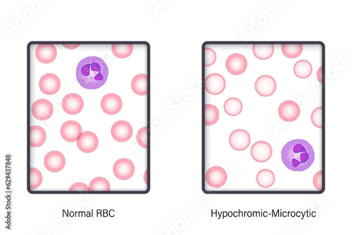 The difference of Normal red blood cell and Hypochromic-Microcytic in light microscope. Blood morphology vector.