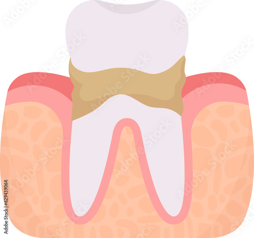 Calculus Tooth Problem