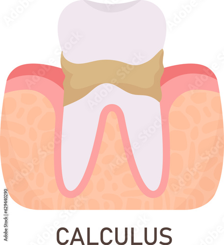 Calculus Tooth Problem