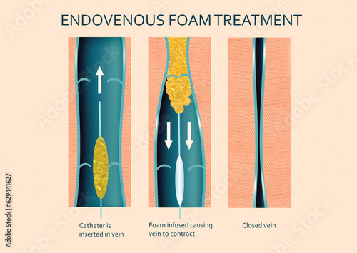 Photography Varicose Veins. Endovenous foam Treatment. Structure of vein